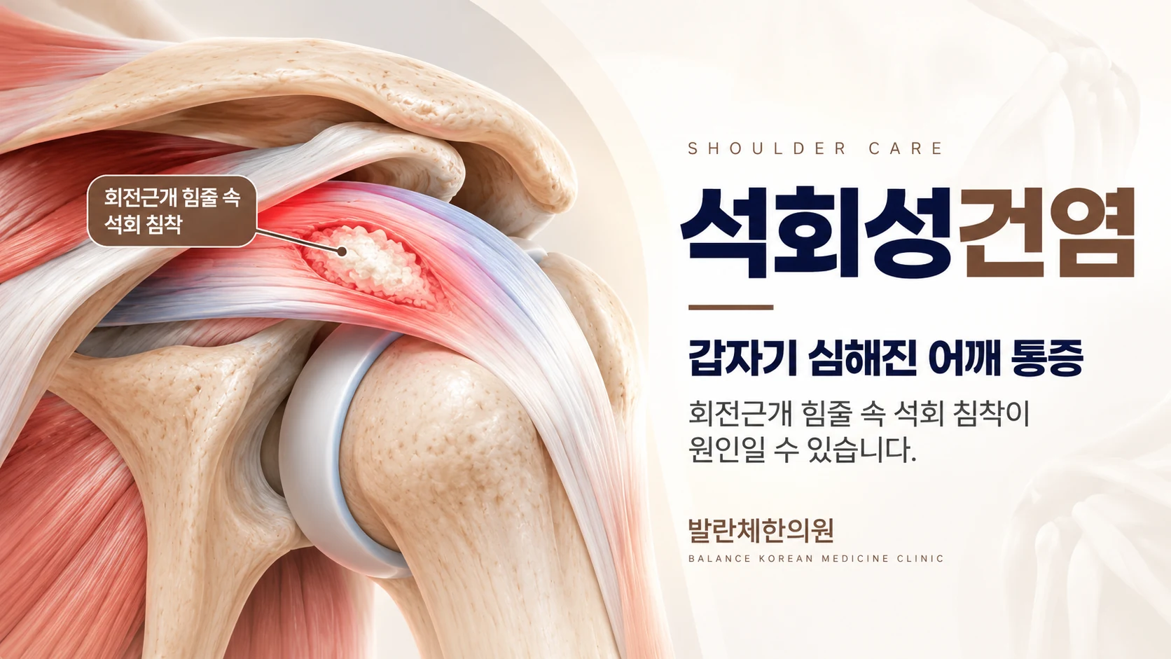 석회성건염으로 갑자기 심해진 어깨 통증과 회전근개 힘줄 속 석회 침착을 나타낸 의료 일러스트