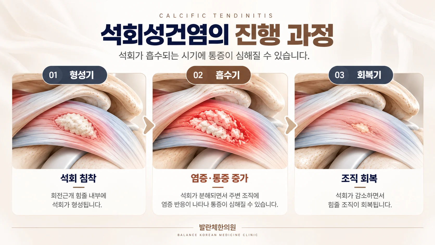 석회성건염 형성기 흡수기 회복기의 석회 침착과 염증 반응을 비교한 의료 일러스트