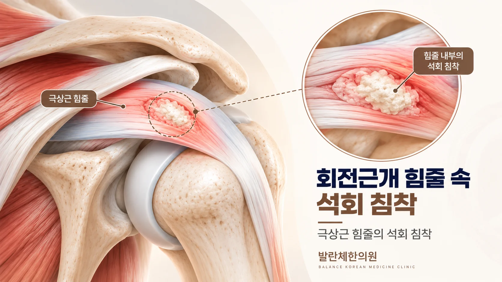 극상근 힘줄 내부의 석회 침착 위치와 확대 구조를 보여주는 석회성건염 의료 일러스트