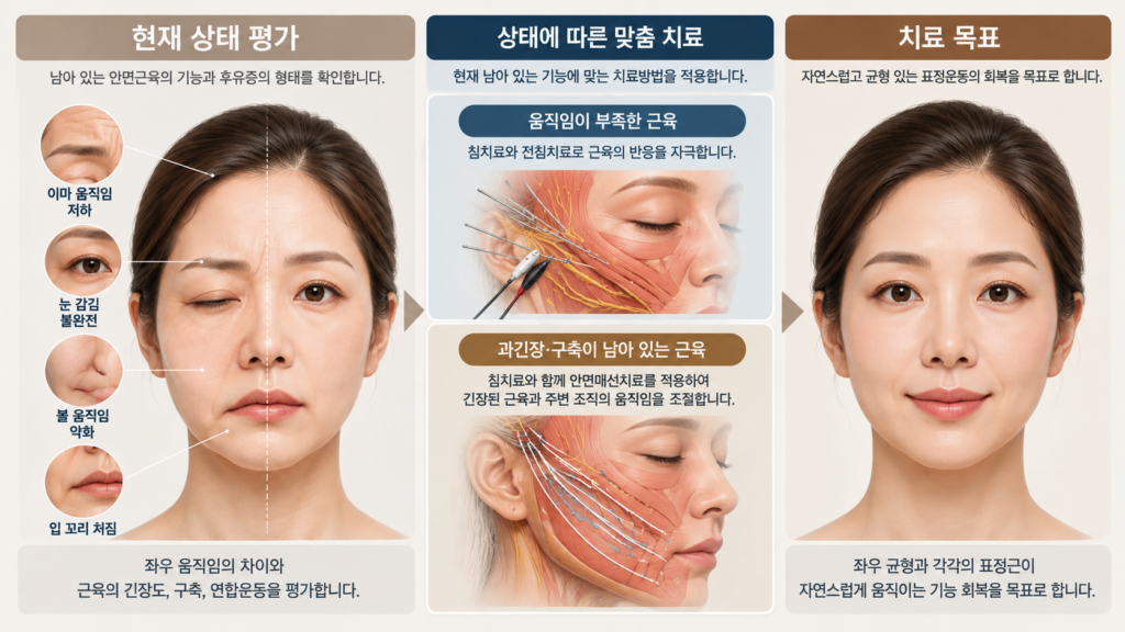 오래된 구안와사의 안면근육 평가와 침 전침 안면매선치료