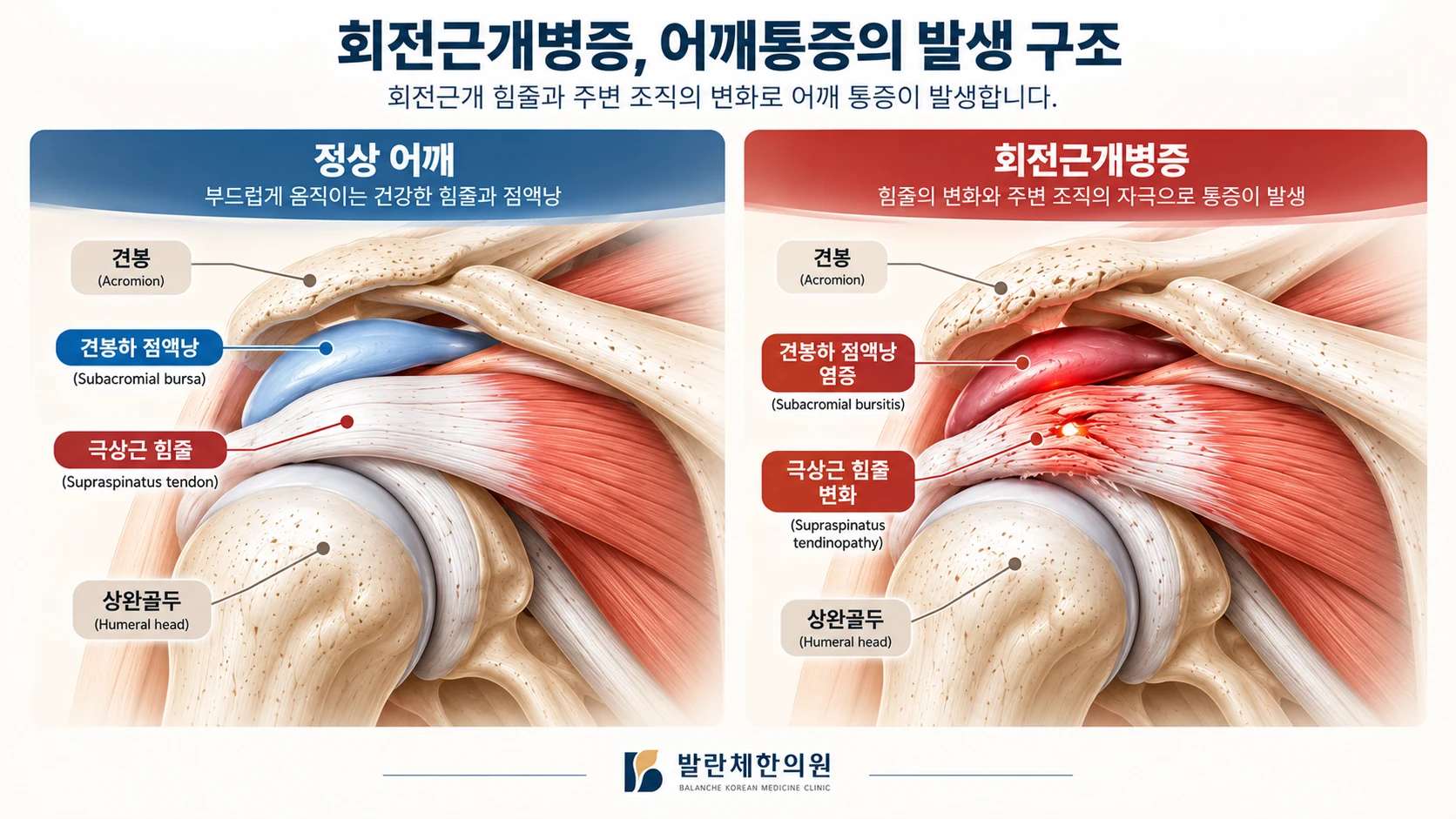 정상 어깨와 회전근개병증의 극상근 힘줄 및 견봉하 점액낭 변화를 비교한 의료 일러스트