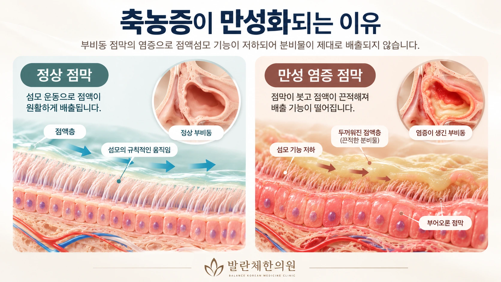 정상 비강 점막과 만성 축농증 염증 점막의 섬모 운동 및 점액 배출 기능 비교