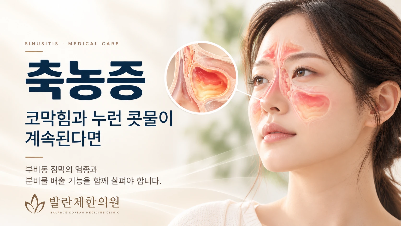 위례 축농증 한의원 발란체한의원 - 부비동 점막 염증과 코막힘을 설명하는 의료 일러스트